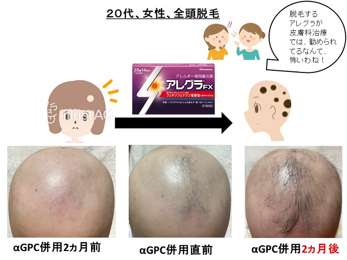 円形脱毛症　病院